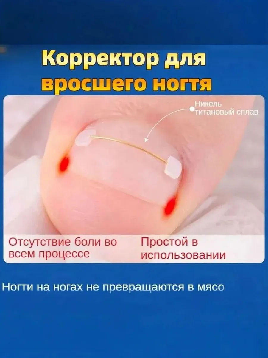Корректор для ногтей от вросшего ногтя Безболезненная дизайн