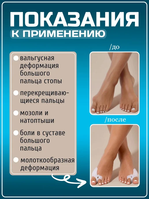 Разделитель для пальцев ног силиконовый бурсопротектор, белый, фото 2